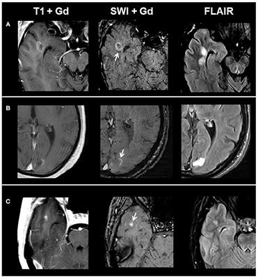 Characterization of Contrast-Enhancing and Non-contrast-enhancing Multiple Sclerosis Lesions Using Susceptibility-Weighted Imaging